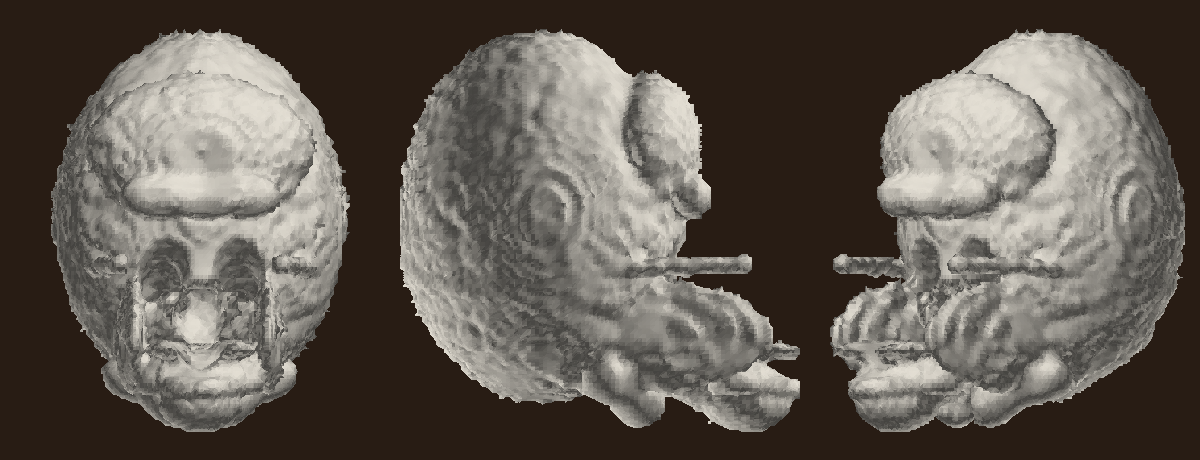 skull render before the fix: concentric crater-ring pattern across the cranial vault
